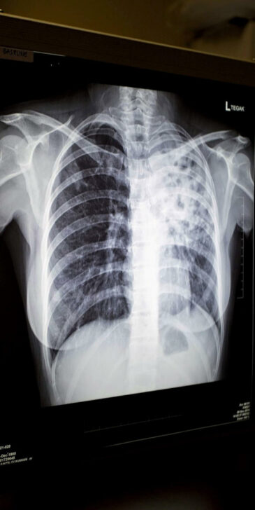 pasien yang terdiagnosa TB paru